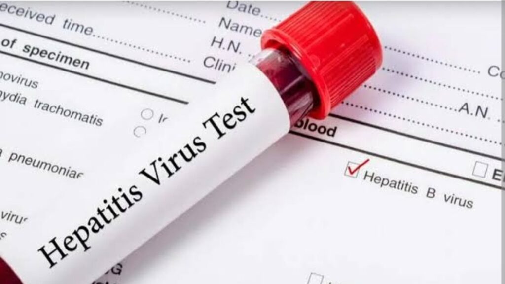 hepatitis