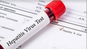 hepatitis